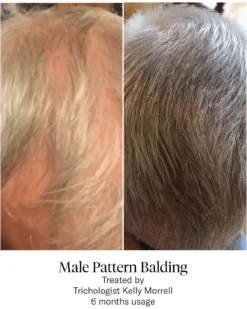 Advanced Hair System Kit Tratamento de Regeneração Capilar