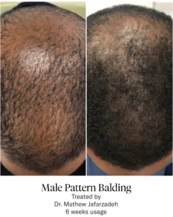 Advanced Hair System Kit Tratamento de Regeneração Capilar