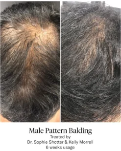 Advanced Hair System Kit Tratamento de Regeneração Capilar
