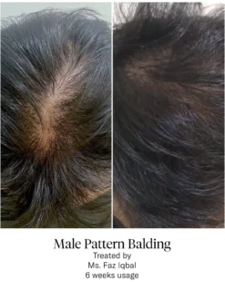 Advanced Hair System Kit Tratamento de Regeneração Capilar