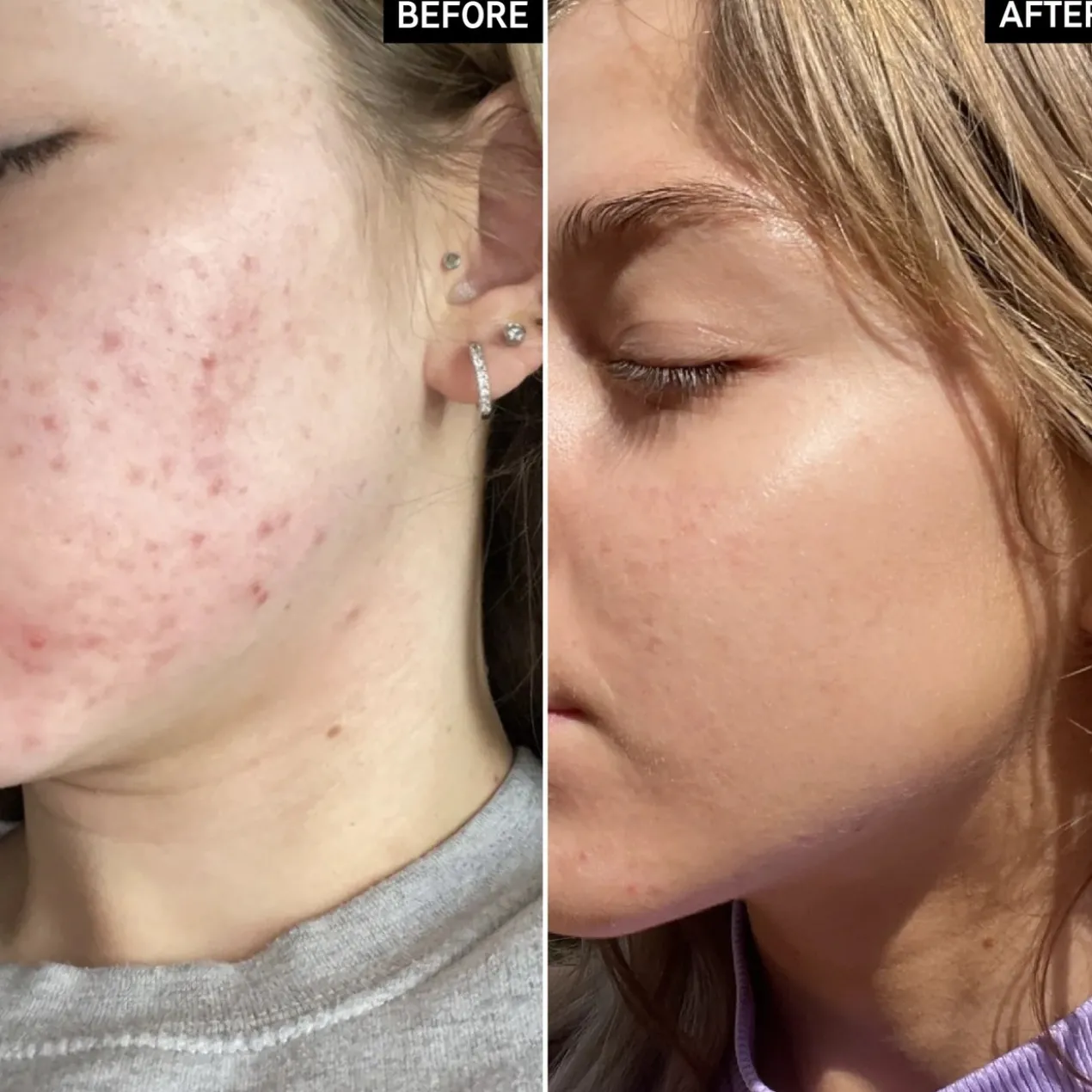 Beta Hydroxy Acid Serum