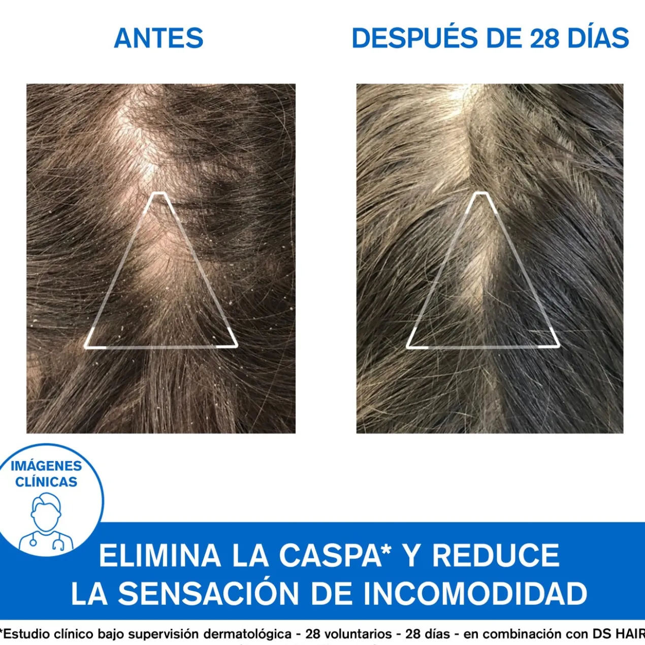 DS Hair Champô Anticaspa