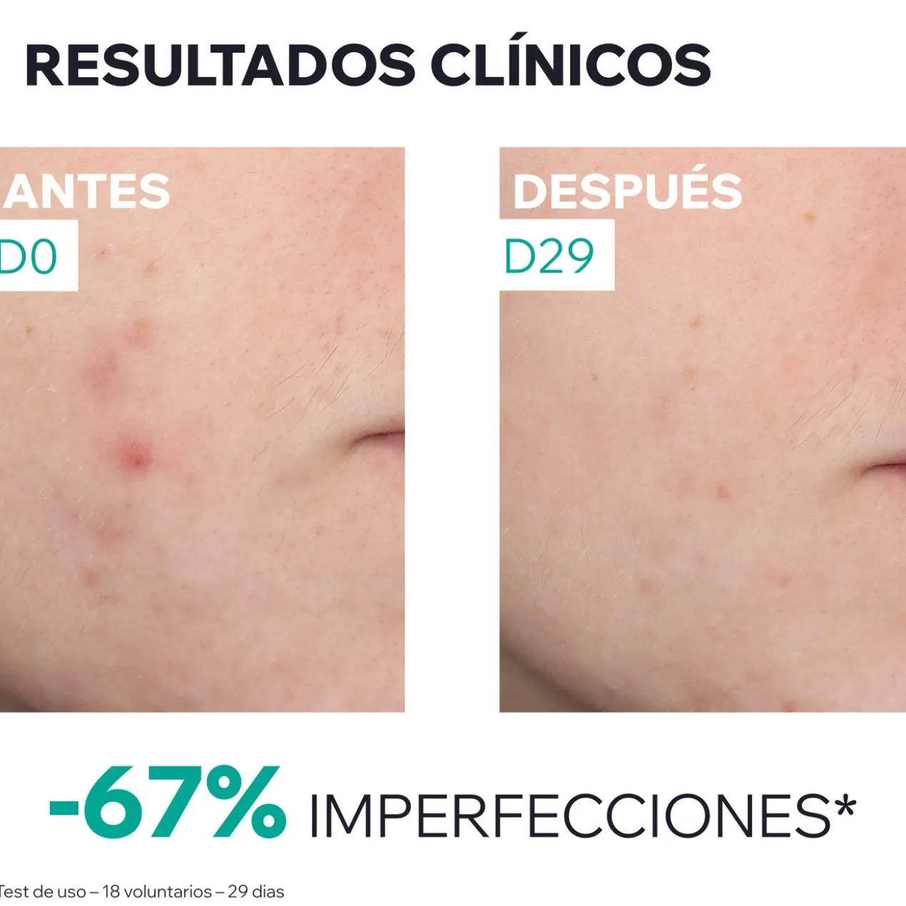 Hyseac Sérum Booster Anti-Imperfeições